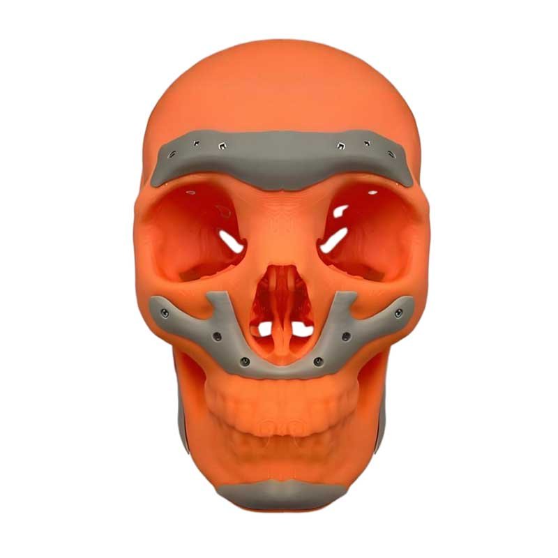 3D Printing of Medical Aesthetics Fillers